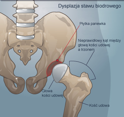 dziecko uczulone na wszystkie pieluchy jednoazowe